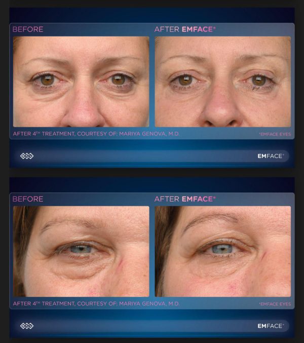 EMFACE Eyes Launch Offer - 6 Emface Eyes & 6 Submentum or 6 Forehead